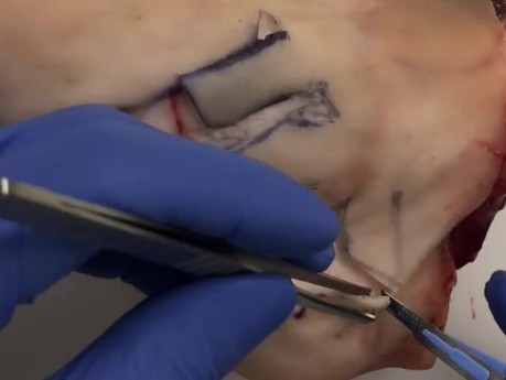 Cirugía de cáncer de piel: el colgajo romboidal