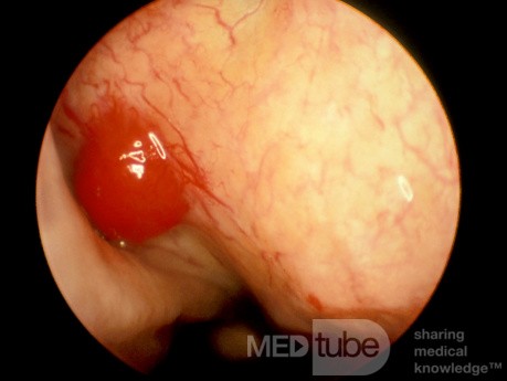 Pequeño hemangioma en la bulla etmoidal