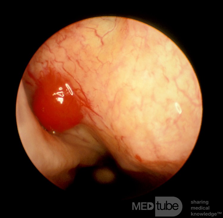Pequeño hemangioma en la bulla etmoidal