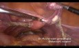 Adnexectomía por un tumor ovárico de bajo potencial maligno (borderline)