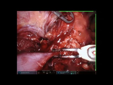 Ressecção de Tumor de Mediastino Robotica