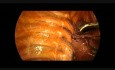 Resección toracoscópica del vértice del pulmón en el neumotórax espontáneo