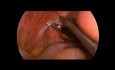 Suprarrenalectomía laparoscópica en niños