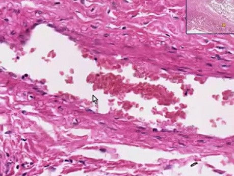 Adhesión - histopatología - pulmón, pleura