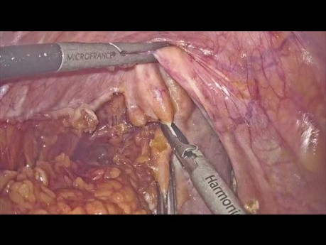 Resección rectal laparoscópica