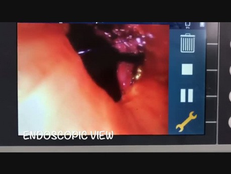 Cirugía torácica asistida por el robot - broncoplastia del bronquio principal izquierdo