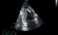 Fibrilación auricular vista en ecocardiograma