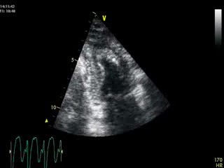 Fibrilación auricular vista en ecocardiograma