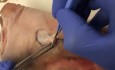 Cirugía de cáncer de piel: colgajo bilobulado