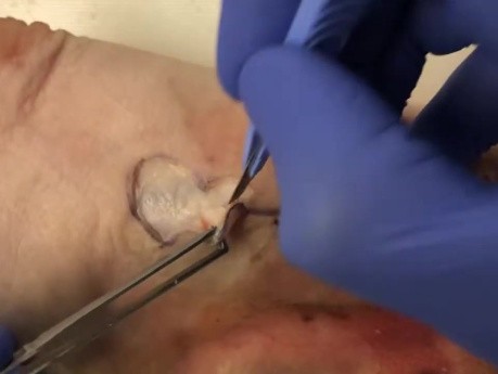 Cirugía de cáncer de piel: colgajo bilobulado