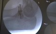 Cirugía de fractura intraarticular de cabeza radial con ORIF