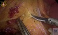 Hemicolectomía derecha laparoscópica por invaginación ileocólica