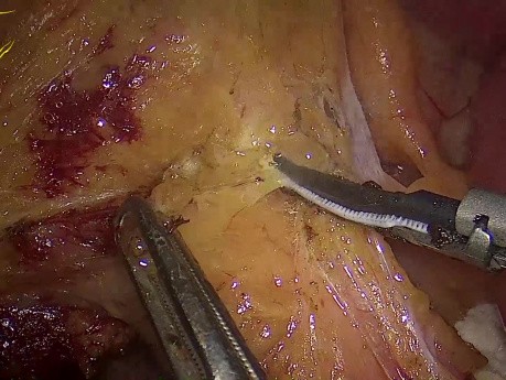 Hemicolectomía derecha laparoscópica por invaginación ileocólica