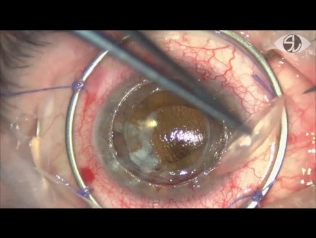 Queratoplastia penetrante con técnica Re-Mushroom (mr-PK)
