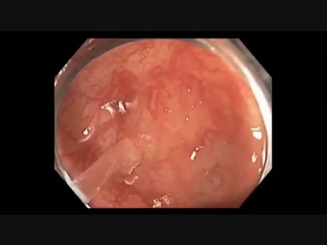 Canal de colonoscopia - cómo identificar una lesión plana sutil