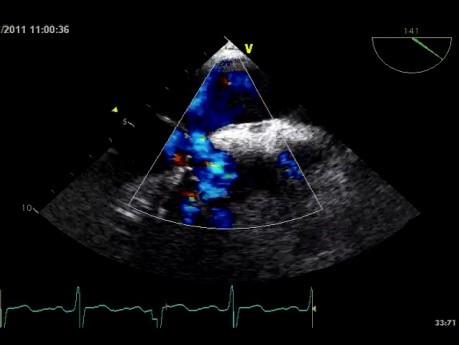 Defecto del tabique interauricular - Ostium Primum