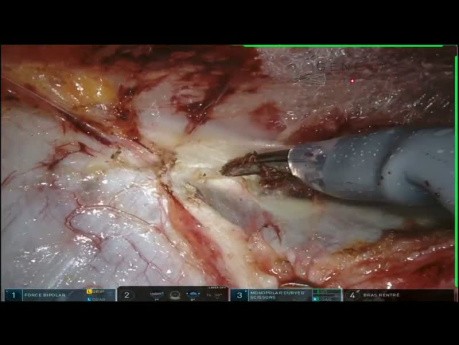 TARUP con TAR unilateral y densificación de malla central