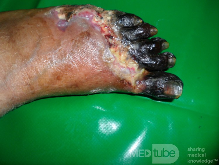 Gangrena del pie diabético (antepié)
