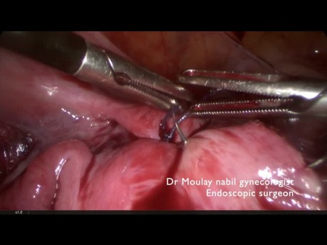 Polimiomectomía ambulatoria con control vascular