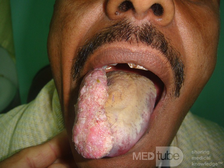 Tumor de lengua