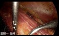Cirugía endoscópica tiroidea transsubclavia con doble puerto (parte 3)