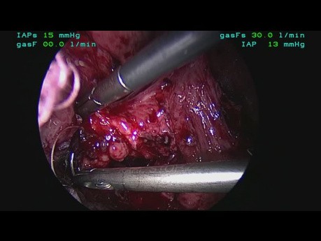 Extracción laparoscópica de malla erosionada con reconstrucción esofágica