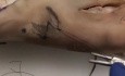 Cirugía de cáncer de piel - Z-Plasty