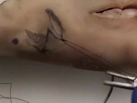 Cirugía de cáncer de piel - Z-Plasty