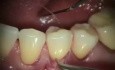 Injerto gingival - la mejor cobertura de recesión