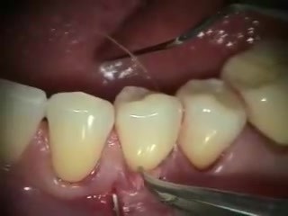 Injerto gingival - la mejor cobertura de recesión