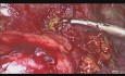 Tratamiento laparoscópico de fístulas colocutánea y colovaginal como complicación de la diverticulosis
