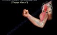 Rotura del tendón del bíceps proximal - video-clase