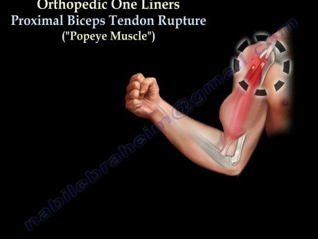 Rotura del tendón del bíceps proximal - video-clase