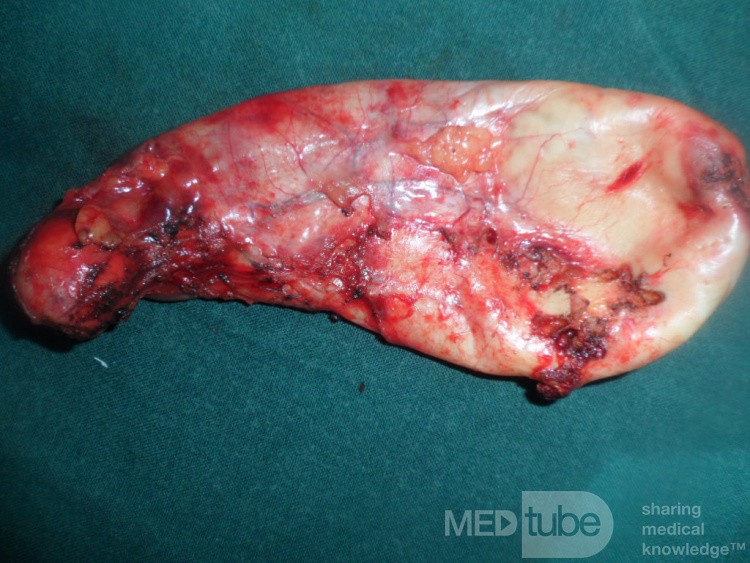 Colecistitis aguda eliminada por colecistectomía laparoscópica