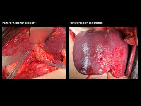 Seccionectomía Posterior Derecha con Resección de la Vena Hepática Derecha por Metástasis de Cáncer de Colon - Presentación de Caso