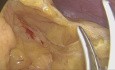 Resección anterior baja con escisión parcial del mesorrecto - Completa - Sin edición
