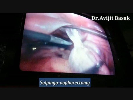 Cirugía laparoscópica para la torsión con quiste ovárico de adhesión densa