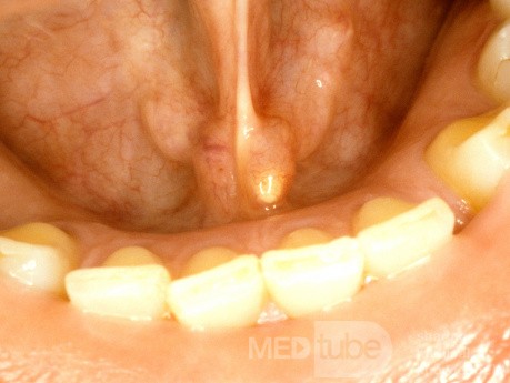 Papila sublingual de piedra