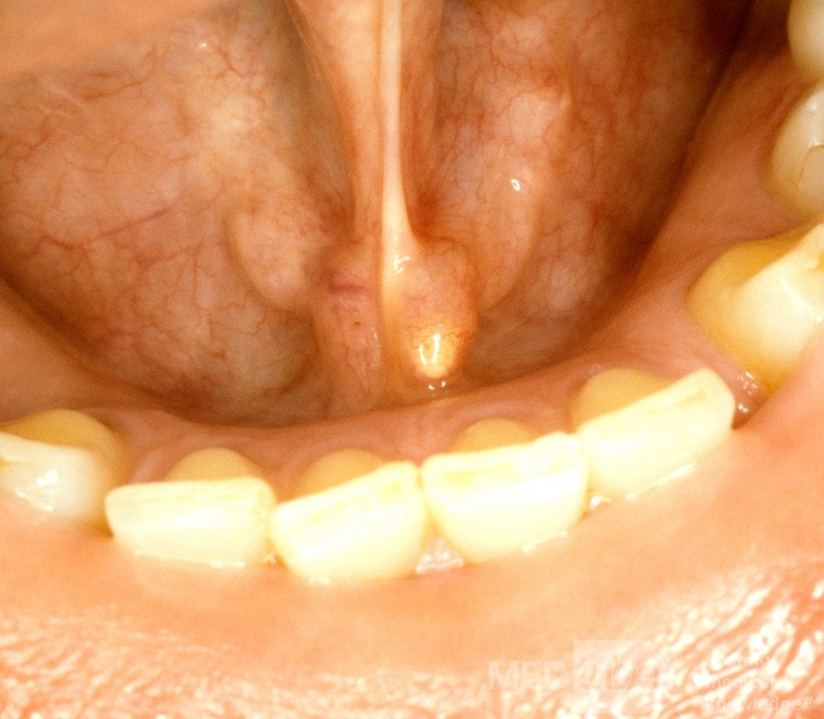 Papila sublingual de piedra