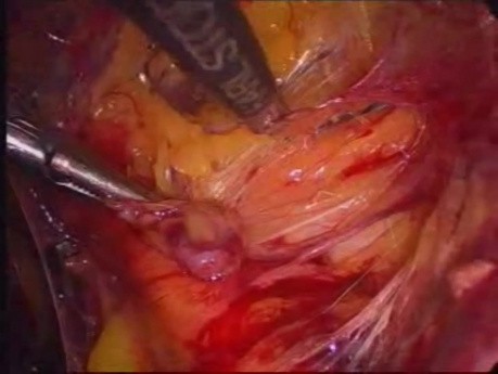 Hernioplastia laparoscópica inguinal total extraperitoneal (TEP) con malla