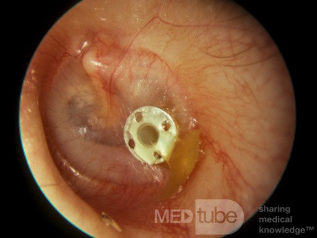 Drenaje de otitis media mucoide del tubo de ventilación