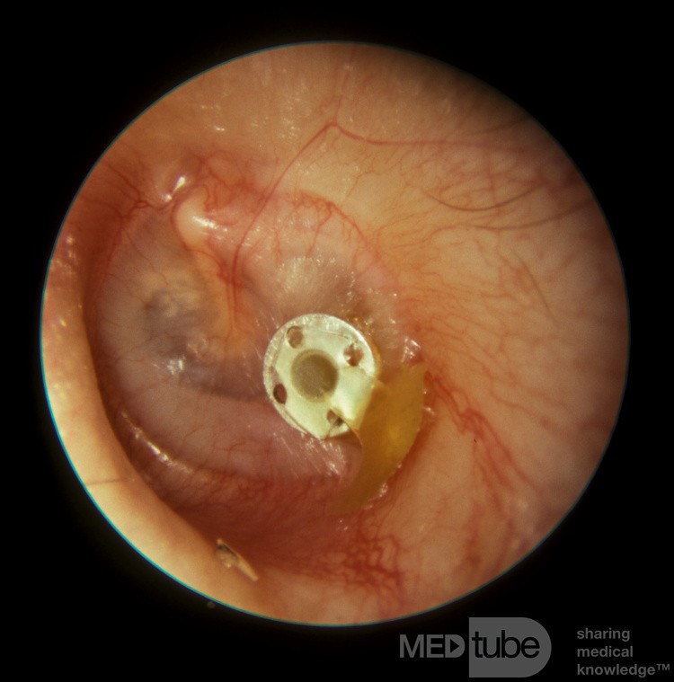 Drenaje de otitis media mucoide del tubo de ventilación