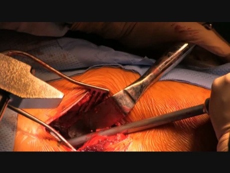 Reemplazo anterior de cadera mínimamente invasivo (tipo Huerter-Judet) por el Dr. Marc Fischer