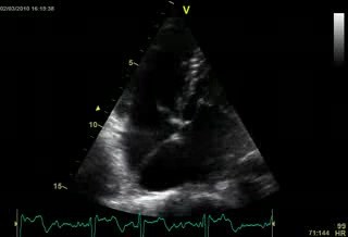 Corazón triauricular