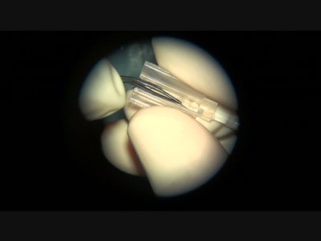 Una extracción de lente artificial calcificada, cápsula intacta, 5 años después de su implantación