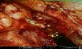 Abordaje infraclavicular robótico: disección mínimamente invasiva del cuello en cánceres de cabeza y cuello