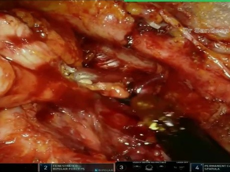 Abordaje infraclavicular robótico: disección mínimamente invasiva del cuello en cánceres de cabeza y cuello