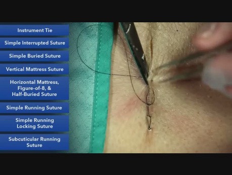 Sutura continua anclada simple - técnicas de sutura