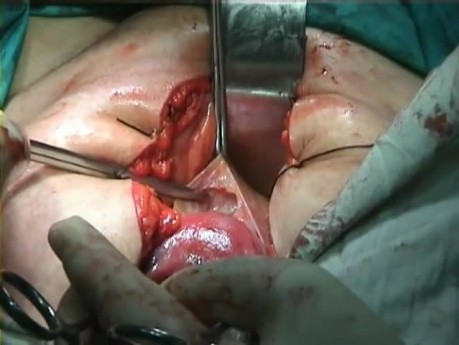 Anatomía del útero - espacio vesicovaginal avascular