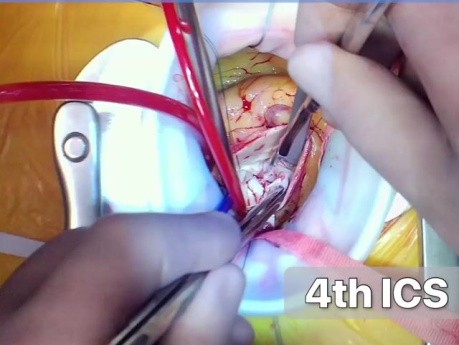 Cirugía de triple válvula + CABG vía LAT